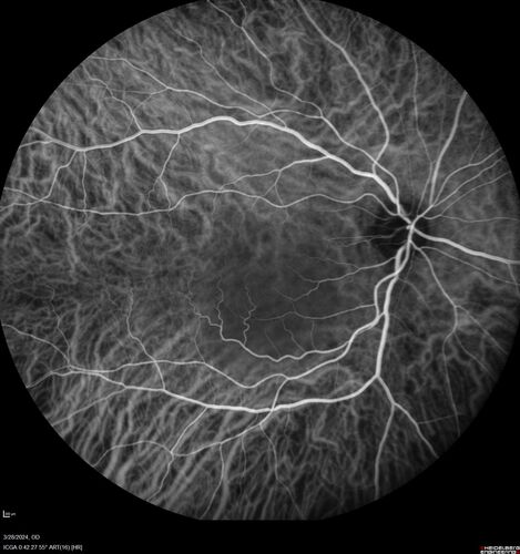 Serous Macular Detachment from Small Choroidal Melanoma
72 year old female misdiagnosed as CSR who had small choroidal melanoms.
