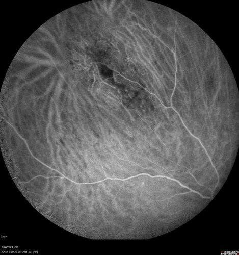 Serous Macular Detachment from Small Choroidal Melanoma
72 year old female misdiagnosed as CSR who had small choroidal melanoms.

