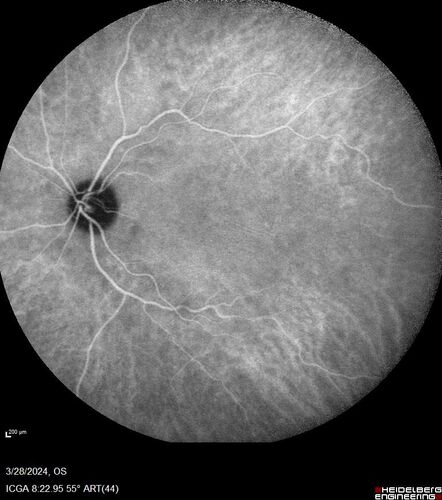 Serous Macular Detachment from Small Choroidal Melanoma
72 year old female misdiagnosed as CSR who had small choroidal melanoms.
