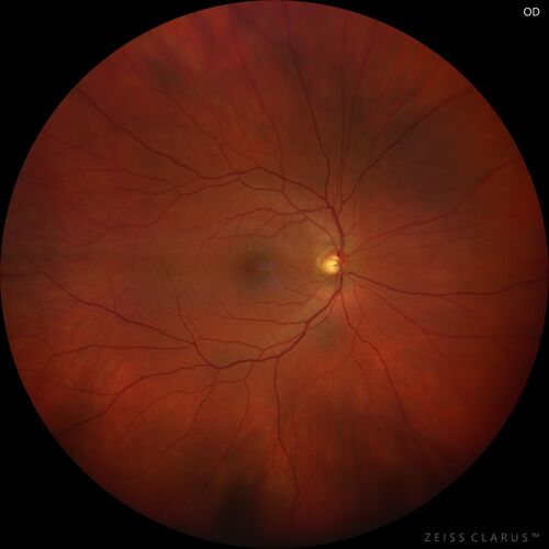 Class 2 choroidal melanoma
48 year old man with no visual complaints referred by optometrist.
Brachytherapy was done and biopsy showed a class 2 melanoma.  2 years later the patient developed liver metastases.
