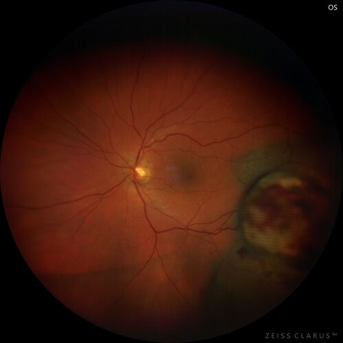 Class 2 choroidal melanoma
48 year old man with no visual complaints referred by optometrist.
Brachytherapy was done and biopsy showed a class 2 melanoma.  2 years later the patient developed liver metastases.
