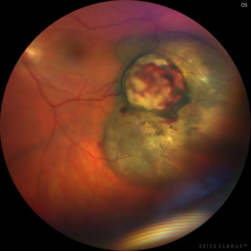 Class 2 choroidal melanoma
48 year old man with no visual complaints referred by optometrist.
Brachytherapy was done and biopsy showed a class 2 melanoma.  2 years later the patient developed liver metastases.
