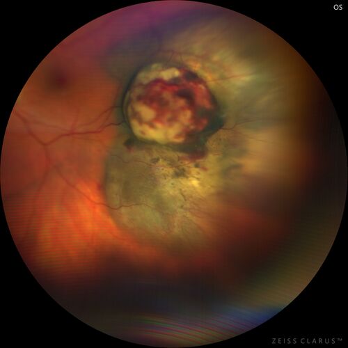 Class 2 choroidal melanoma
48 year old man with no visual complaints referred by optometrist.
Brachytherapy was done and biopsy showed a class 2 melanoma.  2 years later the patient developed liver metastases.
