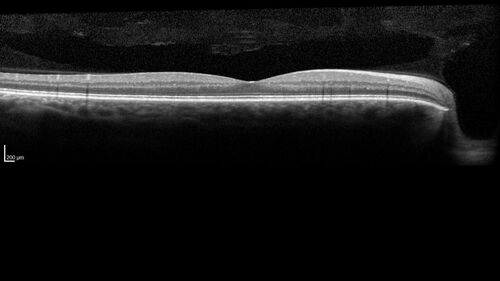 Class 2 choroidal melanoma
48 year old man with no visual complaints referred by optometrist.
Brachytherapy was done and biopsy showed a class 2 melanoma.  2 years later the patient developed liver metastases.
