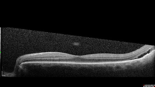 Class 2 choroidal melanoma
48 year old man with no visual complaints referred by optometrist.
Brachytherapy was done and biopsy showed a class 2 melanoma.  2 years later the patient developed liver metastases.
