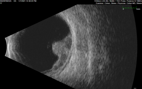 Class 2 choroidal melanoma
48 year old man with no visual complaints referred by optometrist.
Brachytherapy was done and biopsy showed a class 2 melanoma.  2 years later the patient developed liver metastases.
