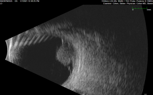 Class 2 choroidal melanoma
48 year old man with no visual complaints referred by optometrist.
Brachytherapy was done and biopsy showed a class 2 melanoma.  2 years later the patient developed liver metastases.
