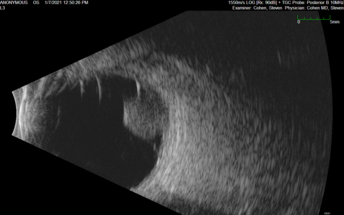 Class 2 choroidal melanoma
48 year old man with no visual complaints referred by optometrist.
Brachytherapy was done and biopsy showed a class 2 melanoma.  2 years later the patient developed liver metastases.
