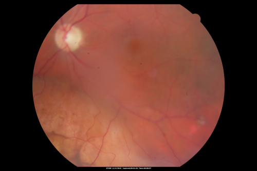 Choroidal Melanoma - Exudative Retinal Detachment 82 Year Old Man 
82-year-old man who had 3 falls 2 weeks ago. After the falls he started checking his vision and noticed there was a veil over the left eye, which he had seen for about two weeks in the superior visual field.  OD 20/25,  OS 20/40
(patient was medically never well enough for brachytherapy and died 6 months later from heart disease) 
