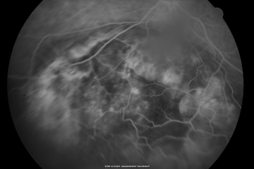 Choroidal Melanoma - Exudative Retinal Detachment 82 Year Old Man 
82-year-old man who had 3 falls 2 weeks ago. After the falls he started checking his vision and noticed there was a veil over the left eye, which he had seen for about two weeks in the superior visual field.  OD 20/25,  OS 20/40
(patient was medically never well enough for brachytherapy and died 6 months later from heart disease) 
