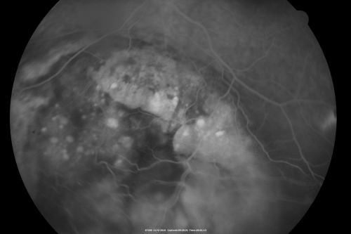 Choroidal Melanoma - Exudative Retinal Detachment 82 Year Old Man 
82-year-old man who had 3 falls 2 weeks ago. After the falls he started checking his vision and noticed there was a veil over the left eye, which he had seen for about two weeks in the superior visual field.  OD 20/25,  OS 20/40
(patient was medically never well enough for brachytherapy and died 6 months later from heart disease) 

