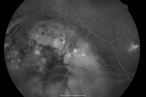 Choroidal Melanoma - Exudative Retinal Detachment 82 Year Old Man 
82-year-old man who had 3 falls 2 weeks ago. After the falls he started checking his vision and noticed there was a veil over the left eye, which he had seen for about two weeks in the superior visual field.  OD 20/25,  OS 20/40
(patient was medically never well enough for brachytherapy and died 6 months later from heart disease) 

