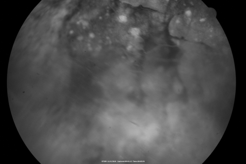 Choroidal Melanoma - Exudative Retinal Detachment 82 Year Old Man 
82-year-old man who had 3 falls 2 weeks ago. After the falls he started checking his vision and noticed there was a veil over the left eye, which he had seen for about two weeks in the superior visual field.  OD 20/25,  OS 20/40
(patient was medically never well enough for brachytherapy and died 6 months later from heart disease) 
