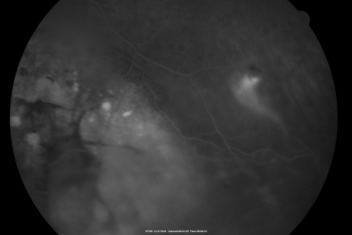 Choroidal Melanoma - Exudative Retinal Detachment 82 Year Old Man 
82-year-old man who had 3 falls 2 weeks ago. After the falls he started checking his vision and noticed there was a veil over the left eye, which he had seen for about two weeks in the superior visual field.  OD 20/25,  OS 20/40
(patient was medically never well enough for brachytherapy and died 6 months later from heart disease) 
