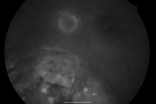 Choroidal Melanoma - Exudative Retinal Detachment 82 Year Old Man 
82-year-old man who had 3 falls 2 weeks ago. After the falls he started checking his vision and noticed there was a veil over the left eye, which he had seen for about two weeks in the superior visual field.  OD 20/25,  OS 20/40
(patient was medically never well enough for brachytherapy and died 6 months later from heart disease) 
