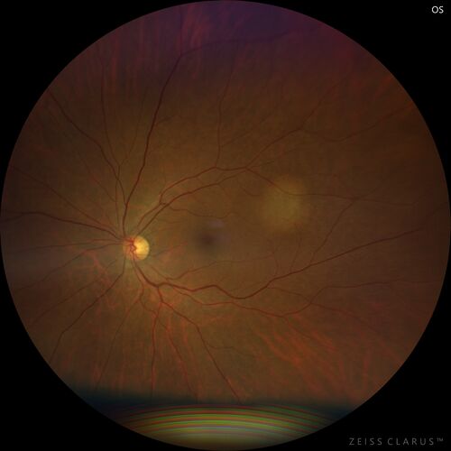 Bilateral Choroidal Tumors - Metastatic Breast Cancer
51 year old female.  First 3 sets of images show lesions growing despite systemic chemotherapy.  She eventually had external beam radiation x 15 sessions and the tumors shrunk in the last two sets of images
