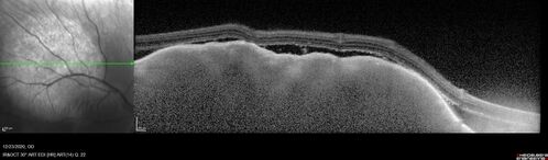 Bilateral Choroidal Tumors - Metastatic Breast Cancer
51 year old female.  First 3 sets of images show lesions growing despite systemic chemotherapy.  She eventually had external beam radiation x 15 sessions and the tumors shrunk in the last two sets of images

