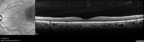 Bilateral Choroidal Tumors - Metastatic Breast Cancer
51 year old female.  First 3 sets of images show lesions growing despite systemic chemotherapy.  She eventually had external beam radiation x 15 sessions and the tumors shrunk in the last two sets of images
