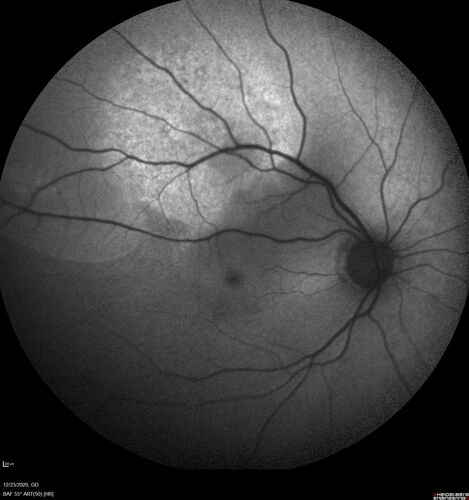 Bilateral Choroidal Tumors - Metastatic Breast Cancer
51 year old female.  First 3 sets of images show lesions growing despite systemic chemotherapy.  She eventually had external beam radiation x 15 sessions and the tumors shrunk in the last two sets of images
