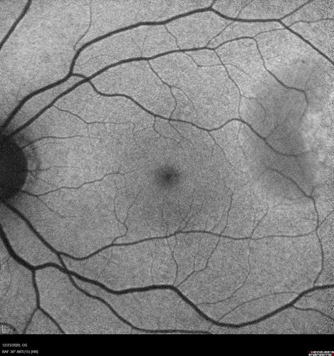 Bilateral Choroidal Tumors - Metastatic Breast Cancer
51 year old female.  First 3 sets of images show lesions growing despite systemic chemotherapy.  She eventually had external beam radiation x 15 sessions and the tumors shrunk in the last two sets of images

