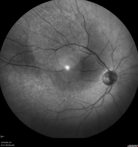 Bilateral Choroidal Tumors - Metastatic Breast Cancer
51 year old female.  First 3 sets of images show lesions growing despite systemic chemotherapy.  She eventually had external beam radiation x 15 sessions and the tumors shrunk in the last two sets of images
