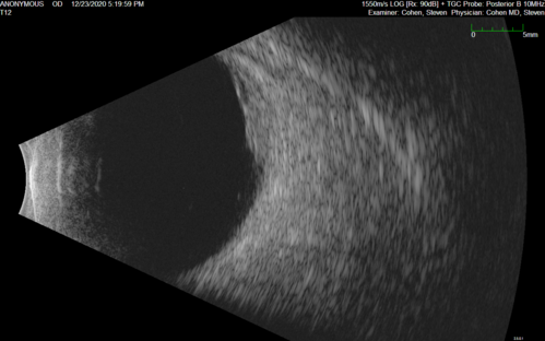 Bilateral Choroidal Tumors - Metastatic Breast Cancer
51 year old female.  First 3 sets of images show lesions growing despite systemic chemotherapy.  She eventually had external beam radiation x 15 sessions and the tumors shrunk in the last two sets of images
