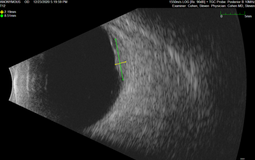 Bilateral Choroidal Tumors - Metastatic Breast Cancer
51 year old female.  First 3 sets of images show lesions growing despite systemic chemotherapy.  She eventually had external beam radiation x 15 sessions and the tumors shrunk in the last two sets of images
