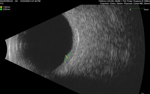 Bilateral Choroidal Tumors - Metastatic Breast Cancer
51 year old female.  First 3 sets of images show lesions growing despite systemic chemotherapy.  She eventually had external beam radiation x 15 sessions and the tumors shrunk in the last two sets of images
