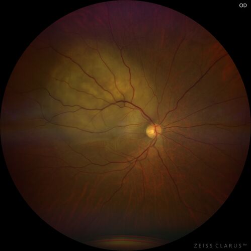 Bilateral Choroidal Tumors - Metastatic Breast Cancer
51 year old female.  First 3 sets of images show lesions growing despite systemic chemotherapy.  She eventually had external beam radiation x 15 sessions and the tumors shrunk in the last two sets of images
