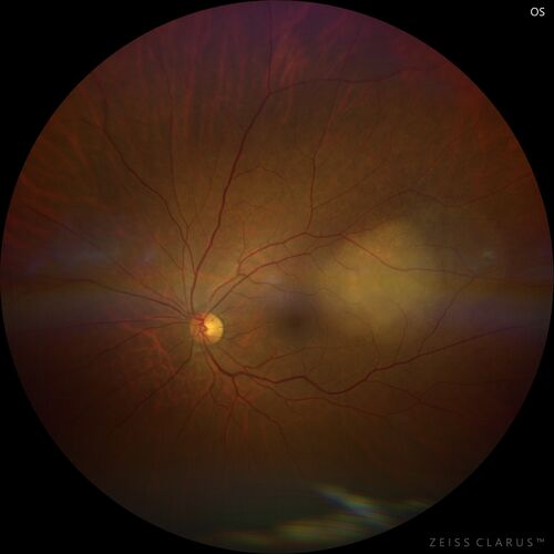 Bilateral Choroidal Tumors - Metastatic Breast Cancer
51 year old female.  First 3 sets of images show lesions growing despite systemic chemotherapy.  She eventually had external beam radiation x 15 sessions and the tumors shrunk in the last two sets of images
