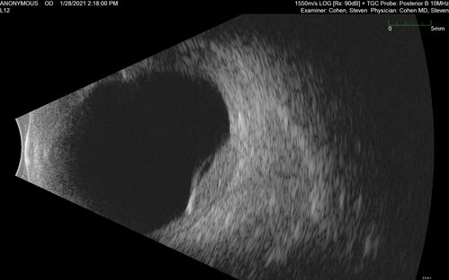 Bilateral Choroidal Tumors - Metastatic Breast Cancer
51 year old female.  First 3 sets of images show lesions growing despite systemic chemotherapy.  She eventually had external beam radiation x 15 sessions and the tumors shrunk in the last two sets of images
