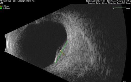 Bilateral Choroidal Tumors - Metastatic Breast Cancer
51 year old female.  First 3 sets of images show lesions growing despite systemic chemotherapy.  She eventually had external beam radiation x 15 sessions and the tumors shrunk in the last two sets of images
