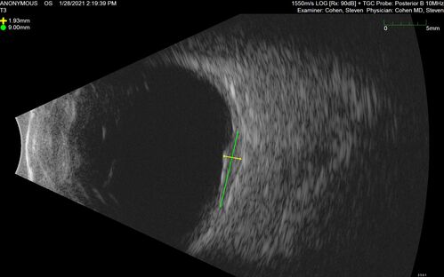 Bilateral Choroidal Tumors - Metastatic Breast Cancer
51 year old female.  First 3 sets of images show lesions growing despite systemic chemotherapy.  She eventually had external beam radiation x 15 sessions and the tumors shrunk in the last two sets of images
