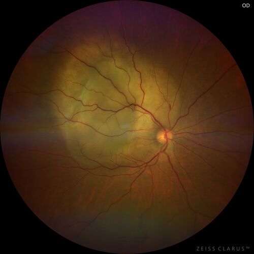 Bilateral Choroidal Tumors - Metastatic Breast Cancer
51 year old female.  First 3 sets of images show lesions growing despite systemic chemotherapy.  She eventually had external beam radiation x 15 sessions and the tumors shrunk in the last two sets of images
