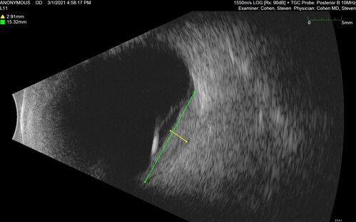 Bilateral Choroidal Tumors - Metastatic Breast Cancer
51 year old female.  First 3 sets of images show lesions growing despite systemic chemotherapy.  She eventually had external beam radiation x 15 sessions and the tumors shrunk in the last two sets of images
