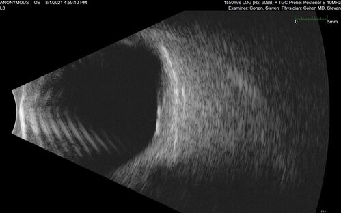 Bilateral Choroidal Tumors - Metastatic Breast Cancer
51 year old female.  First 3 sets of images show lesions growing despite systemic chemotherapy.  She eventually had external beam radiation x 15 sessions and the tumors shrunk in the last two sets of images
