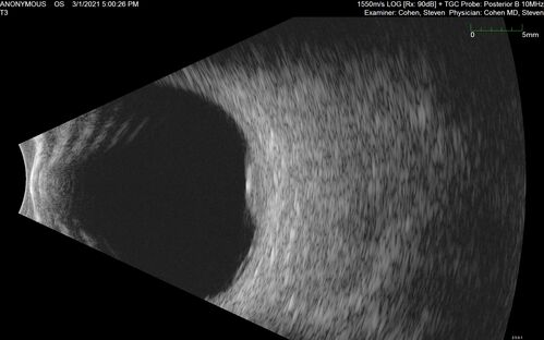 Bilateral Choroidal Tumors - Metastatic Breast Cancer
51 year old female.  First 3 sets of images show lesions growing despite systemic chemotherapy.  She eventually had external beam radiation x 15 sessions and the tumors shrunk in the last two sets of images
