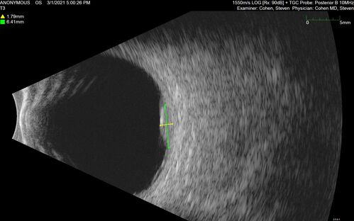 Bilateral Choroidal Tumors - Metastatic Breast Cancer
51 year old female.  First 3 sets of images show lesions growing despite systemic chemotherapy.  She eventually had external beam radiation x 15 sessions and the tumors shrunk in the last two sets of images

