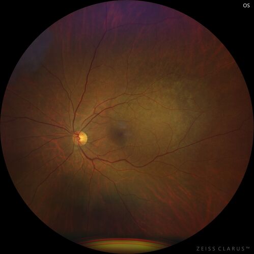 Bilateral Choroidal Tumors - Metastatic Breast Cancer
51 year old female.  First 3 sets of images show lesions growing despite systemic chemotherapy.  She eventually had external beam radiation x 15 sessions and the tumors shrunk in the last two sets of images
