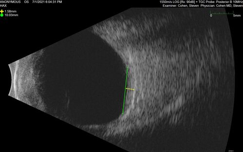 Bilateral Choroidal Tumors - Metastatic Breast Cancer
51 year old female.  First 3 sets of images show lesions growing despite systemic chemotherapy.  She eventually had external beam radiation x 15 sessions and the tumors shrunk in the last two sets of images
