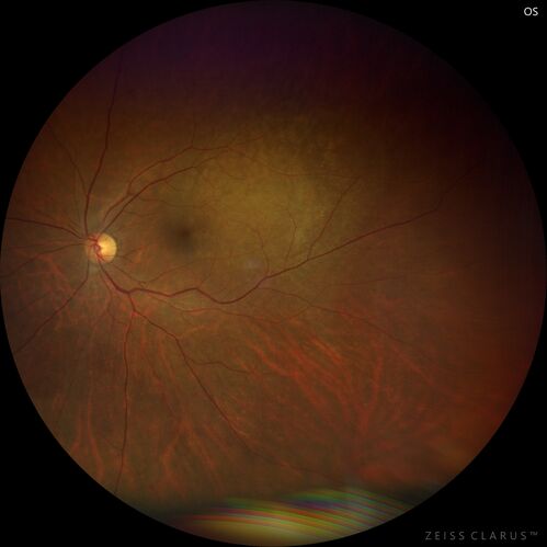Bilateral Choroidal Tumors - Metastatic Breast Cancer
51 year old female.  First 3 sets of images show lesions growing despite systemic chemotherapy.  She eventually had external beam radiation x 15 sessions and the tumors shrunk in the last two sets of images
