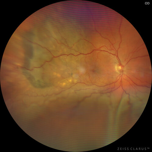 Choroidal Metastatic Breast Cancer with Exudative Detachment
58 year old female presented with 20/200 vision.  Had 10 sessions of radiation and tumor shrank.  The exudative detachment took almost a year to resolve.  The vision improved to 20/40.

