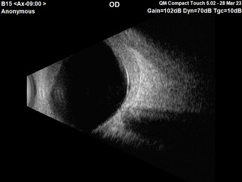 Choroidal Metastatic Breast Cancer with Exudative Detachment
58 year old female presented with 20/200 vision.  Had 10 sessions of radiation and tumor shrank.  The exudative detachment took almost a year to resolve.  The vision improved to 20/40.
