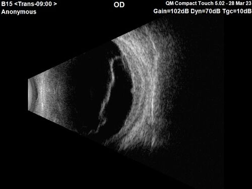 Choroidal Metastatic Breast Cancer with Exudative Detachment
58 year old female presented with 20/200 vision.  Had 10 sessions of radiation and tumor shrank.  The exudative detachment took almost a year to resolve.  The vision improved to 20/40.
