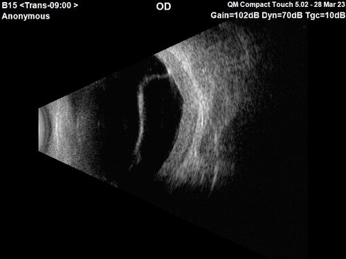 Choroidal Metastatic Breast Cancer with Exudative Detachment
58 year old female presented with 20/200 vision.  Had 10 sessions of radiation and tumor shrank.  The exudative detachment took almost a year to resolve.  The vision improved to 20/40.
