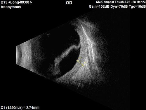 Choroidal Metastatic Breast Cancer with Exudative Detachment
58 year old female presented with 20/200 vision.  Had 10 sessions of radiation and tumor shrank.  The exudative detachment took almost a year to resolve.  The vision improved to 20/40.
