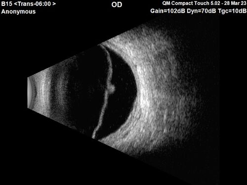 Choroidal Metastatic Breast Cancer with Exudative Detachment
58 year old female presented with 20/200 vision.  Had 10 sessions of radiation and tumor shrank.  The exudative detachment took almost a year to resolve.  The vision improved to 20/40.
