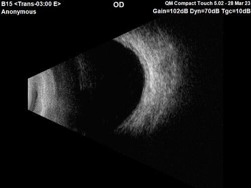 Choroidal Metastatic Breast Cancer with Exudative Detachment
58 year old female presented with 20/200 vision.  Had 10 sessions of radiation and tumor shrank.  The exudative detachment took almost a year to resolve.  The vision improved to 20/40.
