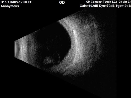 Choroidal Metastatic Breast Cancer with Exudative Detachment
58 year old female presented with 20/200 vision.  Had 10 sessions of radiation and tumor shrank.  The exudative detachment took almost a year to resolve.  The vision improved to 20/40.
