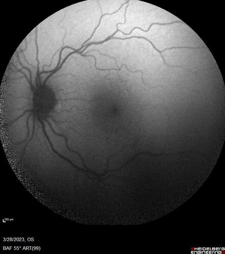 Choroidal Metastatic Breast Cancer with Exudative Detachment
58 year old female presented with 20/200 vision.  Had 10 sessions of radiation and tumor shrank.  The exudative detachment took almost a year to resolve.  The vision improved to 20/40.
